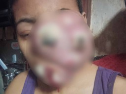 Anisa Alami Benjolan Besar di Wajah Pasca Operasi Hidung di RSUD Dr. Soetomo