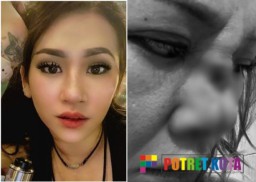 Presenter TV Diduga Korban Malpraktek Dokter Spesialis