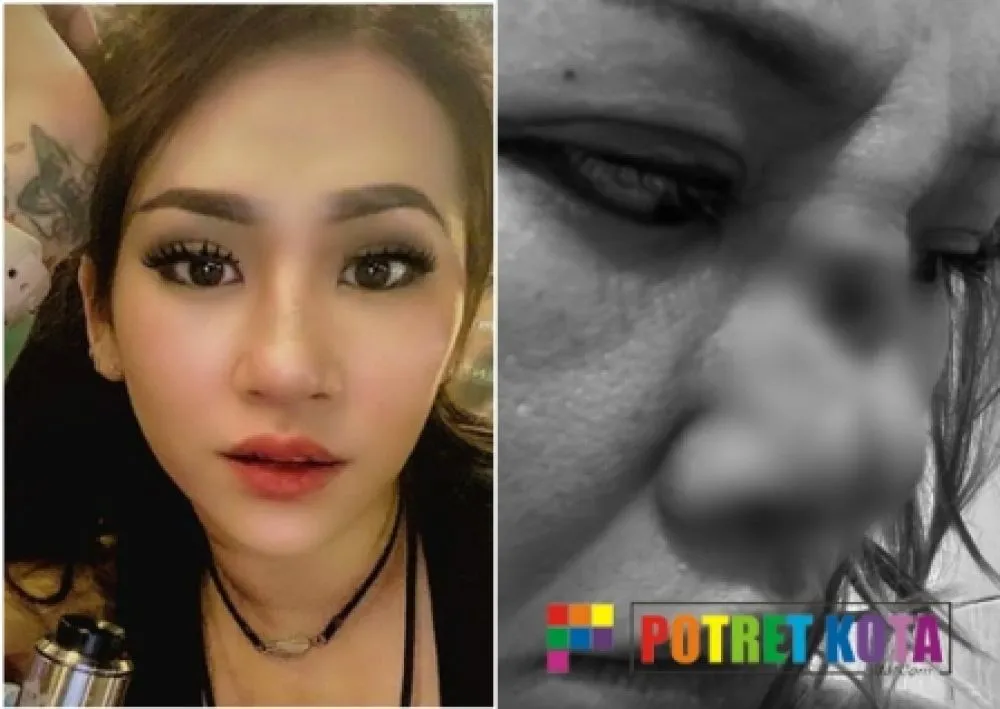 Presenter TV Diduga Korban Malpraktek Dokter Spesialis