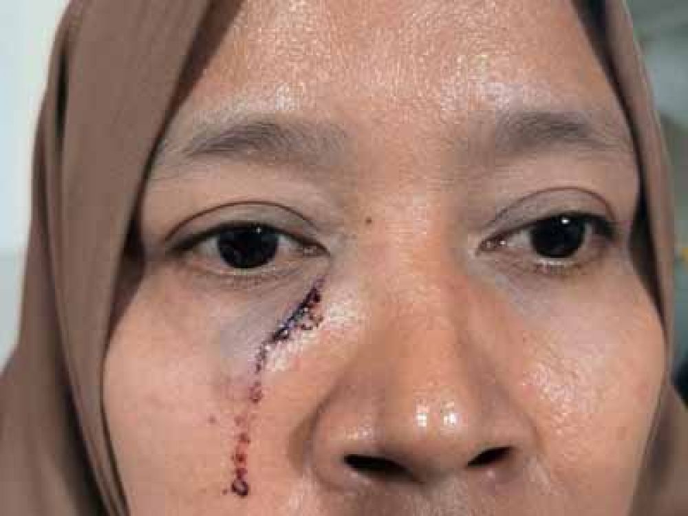 Siti Asiyah mengalami luka di bagian wajah pasca dikeroyok Fitria (ibu) dan Wulan Hijriyah (anak), Jumat, (18/10/2024), sekitar pukul19.30 WIB.